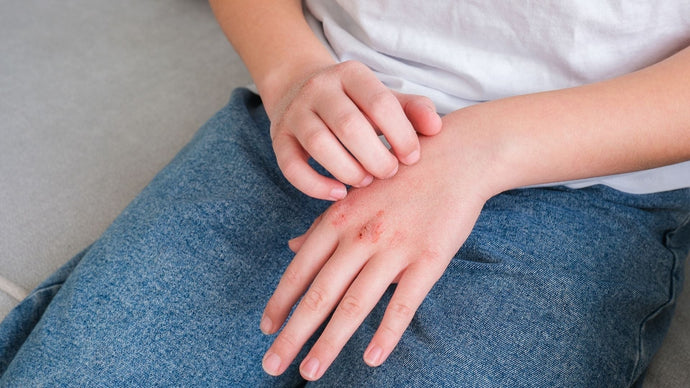 7 Cara Mengatasi Kulit Bersisik dan Gatal